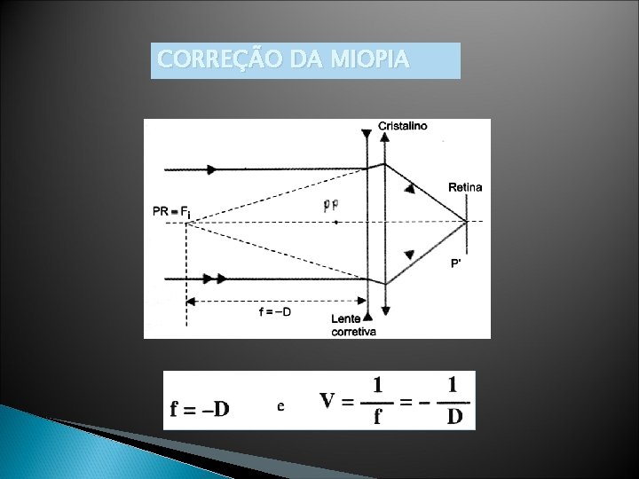 CORREÇÃO DA MIOPIA 