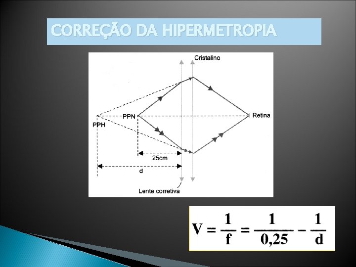 CORREÇÃO DA HIPERMETROPIA 