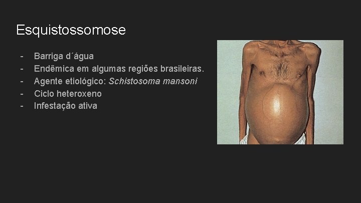 Esquistossomose - Barriga d´água Endêmica em algumas regiões brasileiras. Agente etiológico: Schistosoma mansoni Ciclo