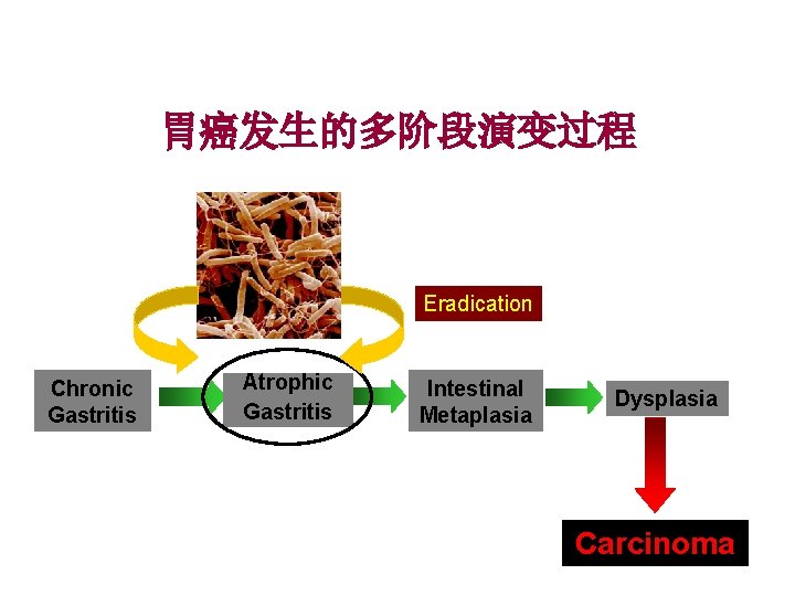 胃癌发生的多阶段演变过程 Eradication Chronic Gastritis Atrophic Gastritis Intestinal Metaplasia Dysplasia Carcinoma 