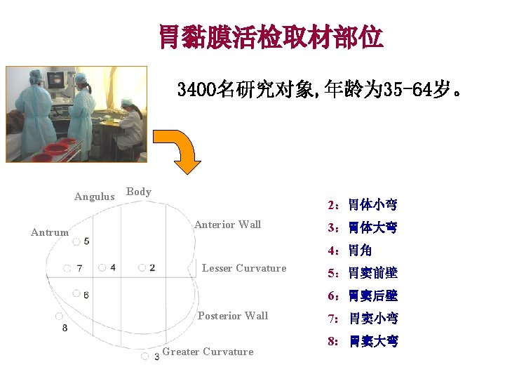 胃黏膜活检取材部位 3400名研究对象, 年龄为 35 -64岁。 Angulus Antrum Body 2：胃体小弯 Anterior Wall 3：胃体大弯 4：胃角 Lesser