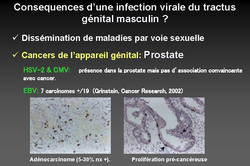 Consequences d’une infection virale du tractus génital masculin ? ü Dissémination de maladies par