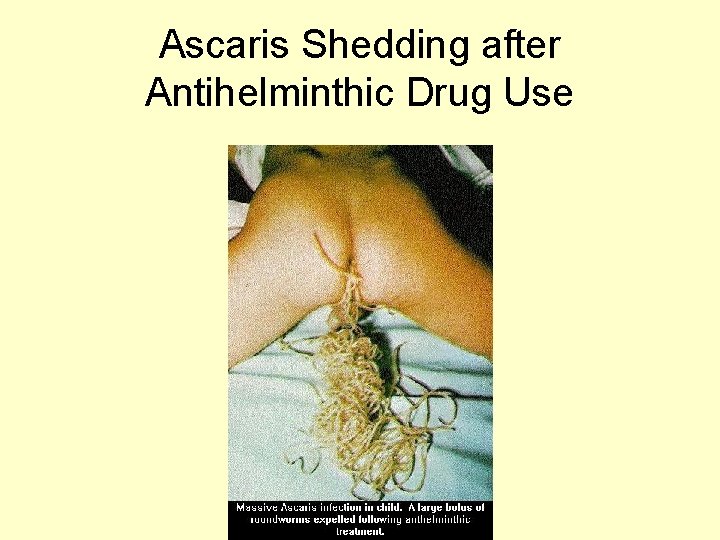 Ascaris Shedding after Antihelminthic Drug Use 