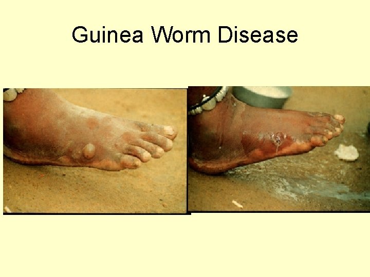 Guinea Worm Disease 