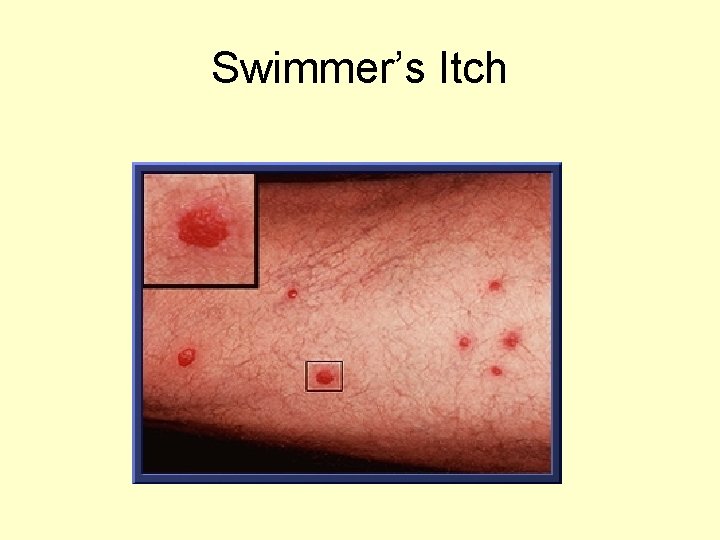 Swimmer’s Itch 