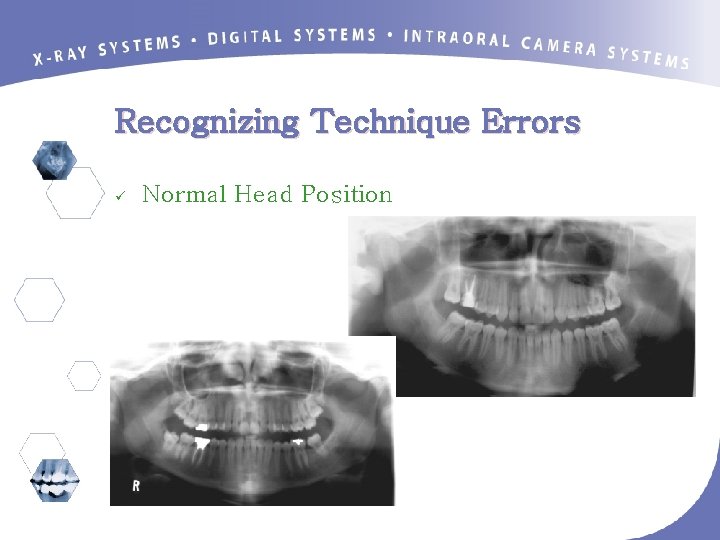 Recognizing Technique Errors ü Normal Head Position 