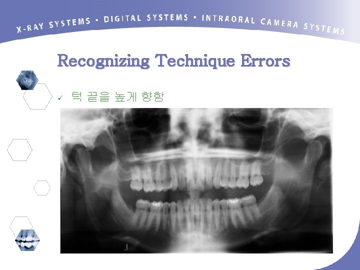 Recognizing Technique Errors ü 턱 끝을 높게 향함 