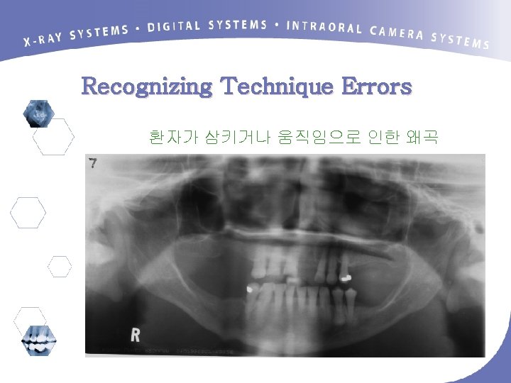 Recognizing Technique Errors 환자가 삼키거나 움직임으로 인한 왜곡 