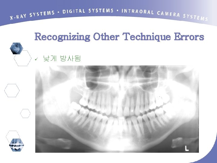 Recognizing Other Technique Errors ü 낮게 방사됨 