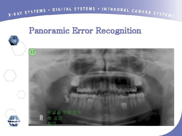 Panoramic Error Recognition 17 턱끝을 위로 향함 혀 공간 회전 