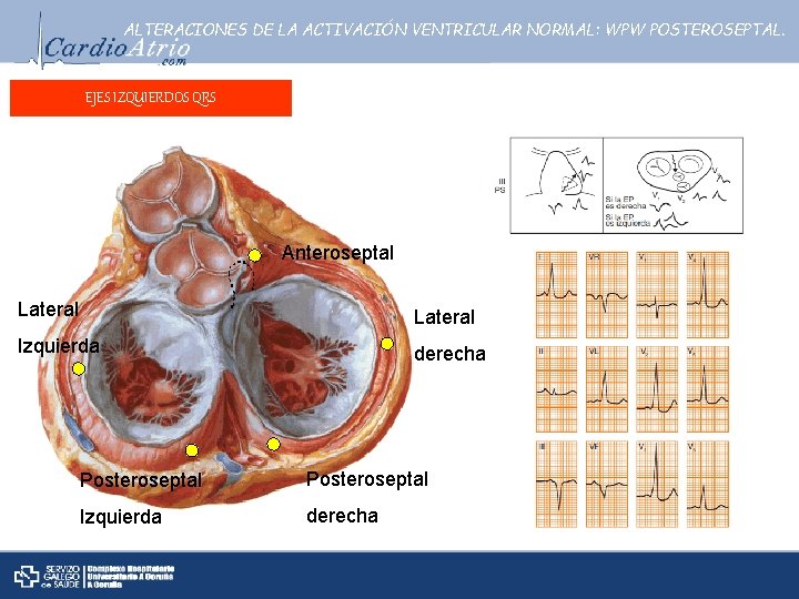 ALTERACIONES DE LA ACTIVACIÓN VENTRICULAR NORMAL: WPW POSTEROSEPTAL. EJES IZQUIERDOS QRS Anteroseptal Lateral Izquierda