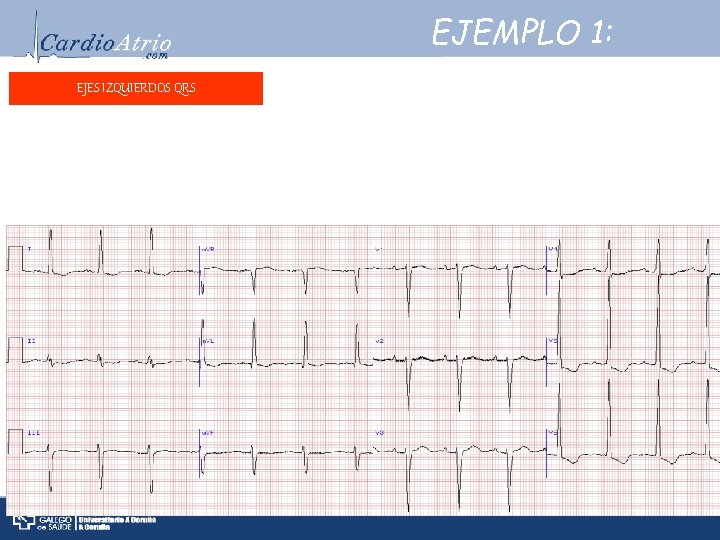 EJEMPLO 1: EJES IZQUIERDOS QRS Frecuencia: ± 84 lpm. Ritmo: Sinusal. eléctrico: Eje eléctrico: