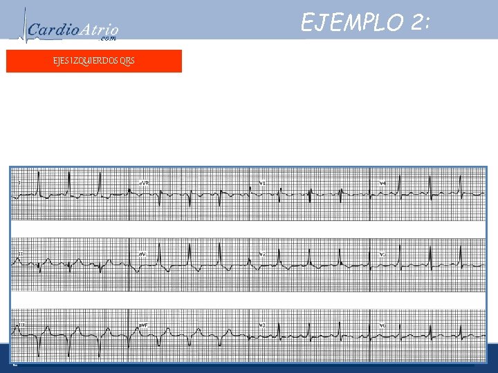 EJEMPLO 2: EJES IZQUIERDOS QRS Frecuencia: ± 93 lpm. Ritmo: Sinusal. Eje eléctrico: -