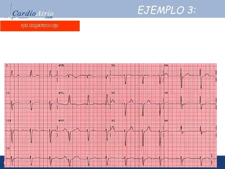 EJEMPLO 3: EJES IZQUIERDOS QRS Frecuencia: 70 Frecuencia: Ritmo: sinusal. eléctrico: Eje eléctrico: aproximadamente