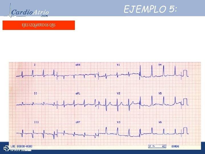 EJEMPLO 5: EJES IZQUIERDOS QRS Frecuencia: ± 100 lpm. Frecuencia: Ritmo: Sinusal. Ritmo: Ejeeléctrico: