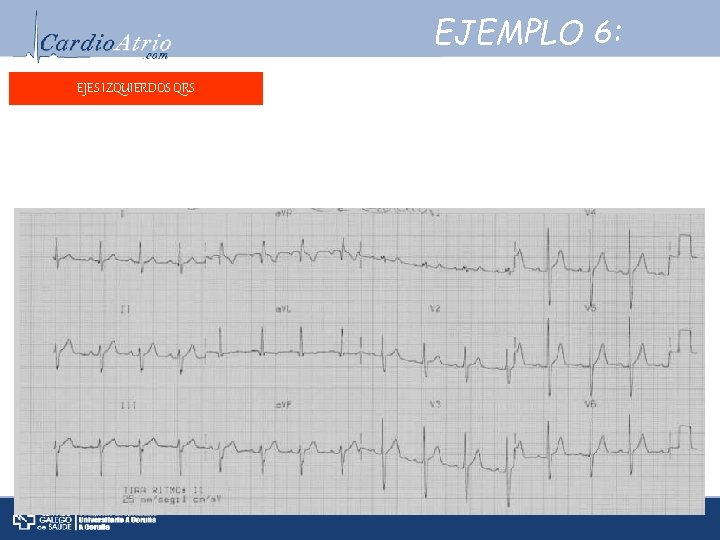 EJEMPLO 6: EJES IZQUIERDOS QRS Frecuencia: ± 90 lpm. Frecuencia: Ritmo: Sinusal. Ritmo: Eje