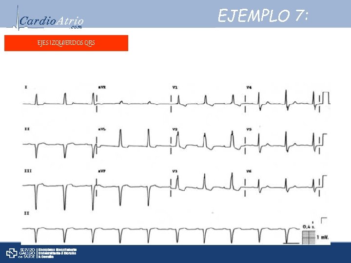 EJEMPLO 7: EJES IZQUIERDOS QRS Frecuencia: ± 60 lpm. Ritmo: Sinusal. Ejeeléctrico: -30° Onda.