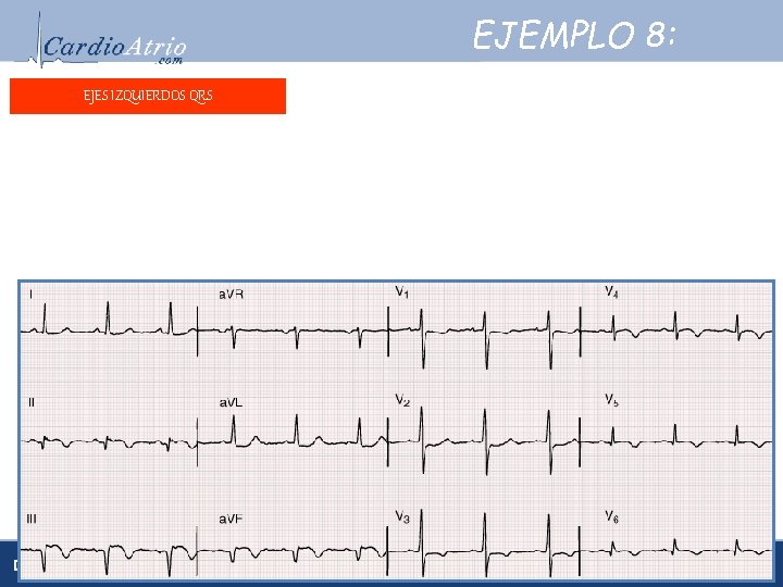 EJEMPLO 8: EJES IZQUIERDOS QRS Frecuencia: ± 72 lpm. Frecuencia: Ritmo: Sinusal. Ritmo: Eje