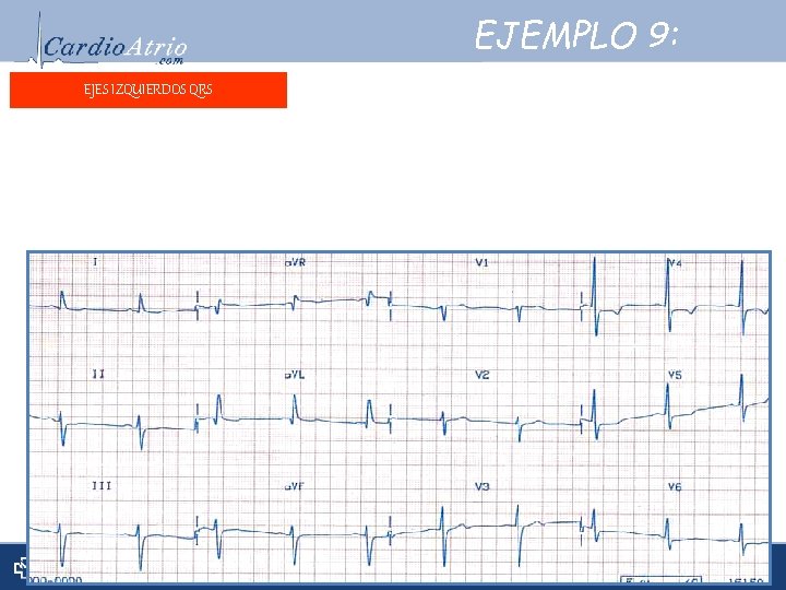 EJEMPLO 9: EJES IZQUIERDOS QRS Frecuencia: ± 60 lpm. Frecuencia: Ritmo: Sinusal. Ritmo: Eje