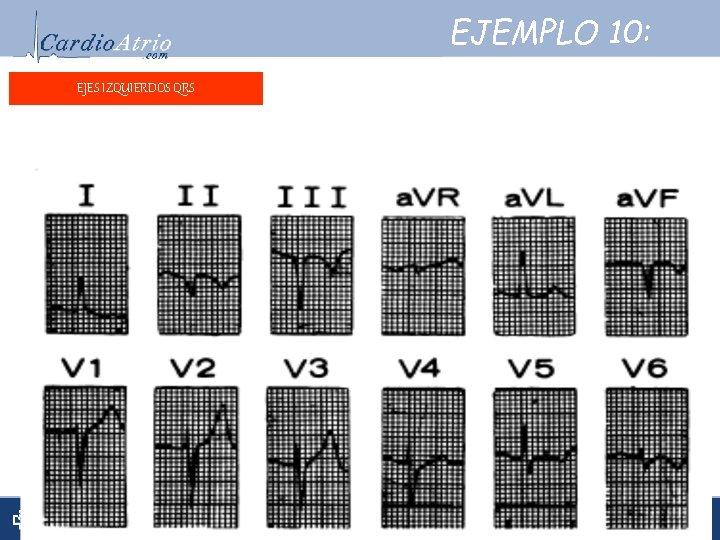EJEMPLO 10: EJES IZQUIERDOS QRS Frecuencia: Ritmo: Sinusal. Ritmo: eléctrico: -50° Ejeeléctrico: Onda. P: