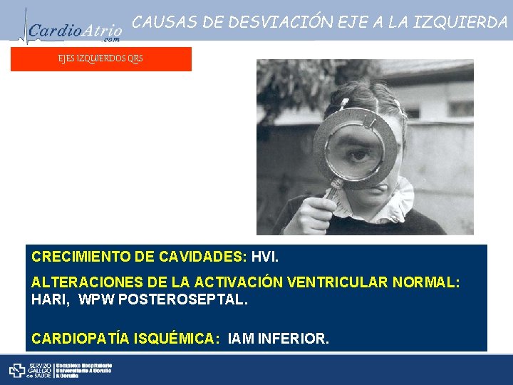 CAUSAS DE DESVIACIÓN EJE A LA IZQUIERDA EJES IZQUIERDOS QRS CRECIMIENTO DE CAVIDADES: HVI.