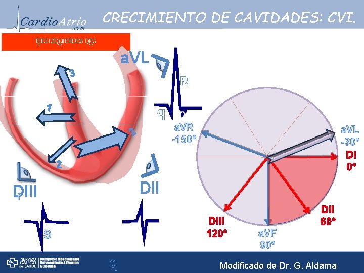 CRECIMIENTO DE CAVIDADES: CVI. EJES IZQUIERDOS QRS a. VL 3 R 1 q a.