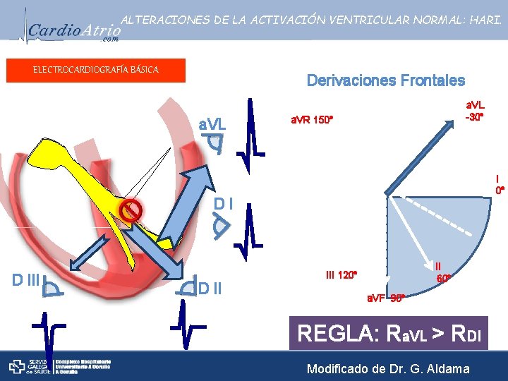 ALTERACIONES DE LA ACTIVACIÓN VENTRICULAR NORMAL: HARI. ELECTROCARDIOGRAFÍA BÁSICA Derivaciones Frontales a. VL -30