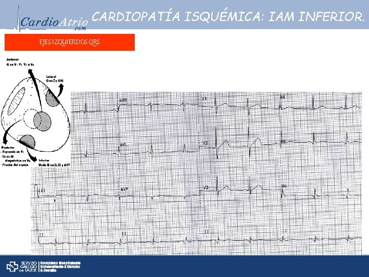 CARDIOPATÍA ISQUÉMICA: IAM INFERIOR. EJES IZQUIERDOS QRS 