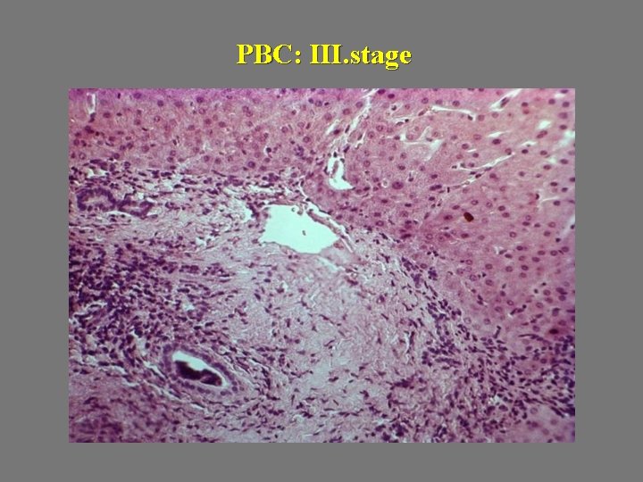 PBC: III. stage 