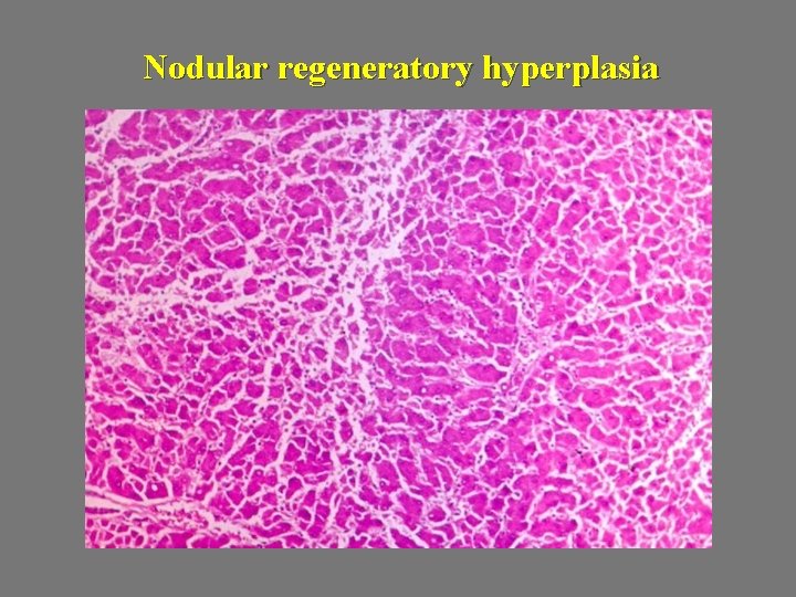 Nodular regeneratory hyperplasia 