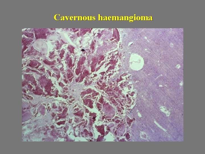 Cavernous haemangioma 