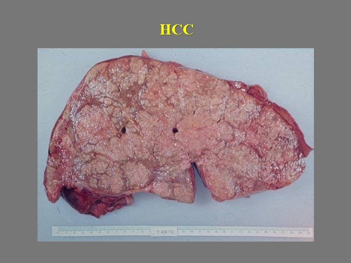 HCC 