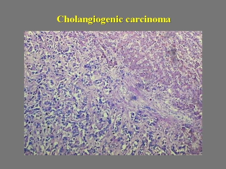 Cholangiogenic carcinoma 