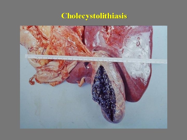 Cholecystolithiasis 