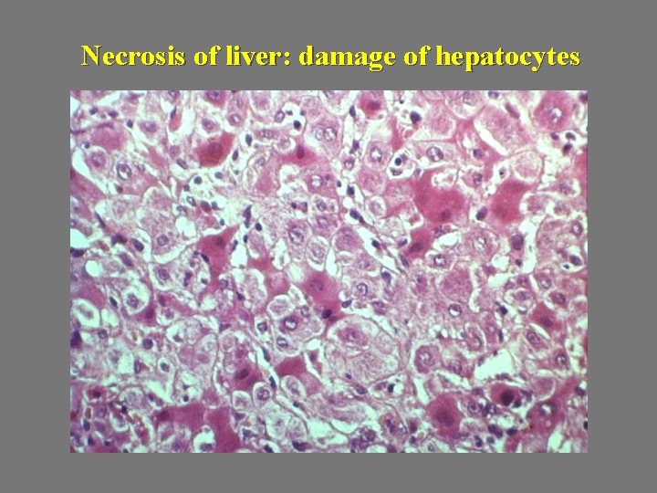 Necrosis of liver: damage of hepatocytes 