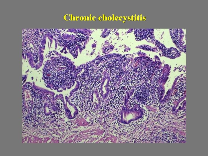 Chronic cholecystitis 