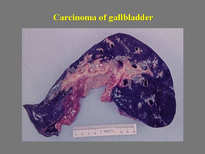 Carcinoma of gallbladder 