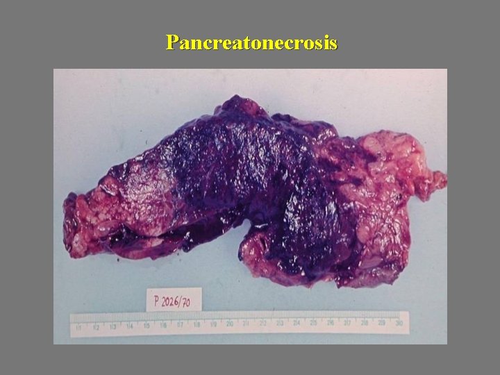 Pancreatonecrosis 