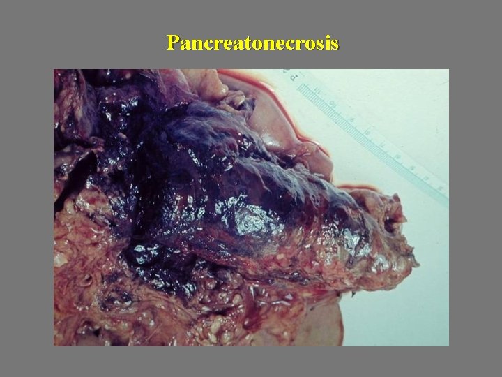 Pancreatonecrosis 