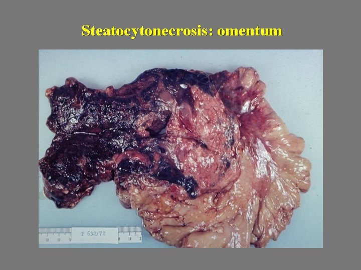 Steatocytonecrosis: omentum 