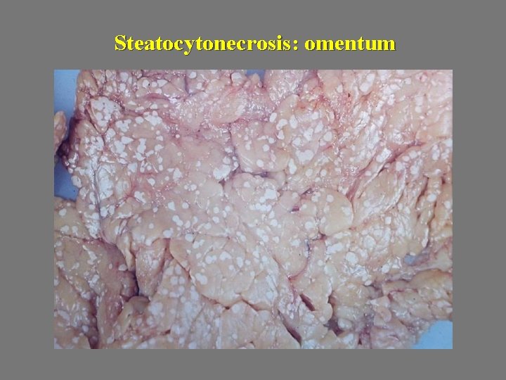 Steatocytonecrosis: omentum 