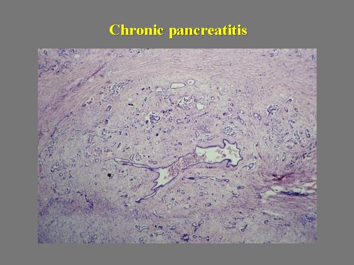 Chronic pancreatitis 