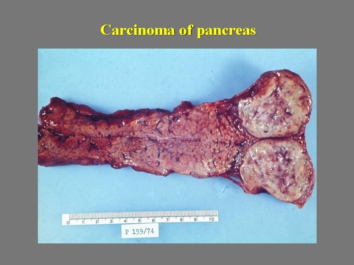 Carcinoma of pancreas 