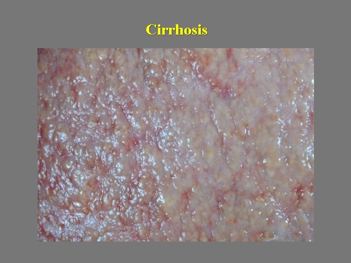 Cirrhosis 
