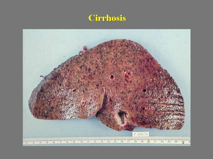 Cirrhosis 