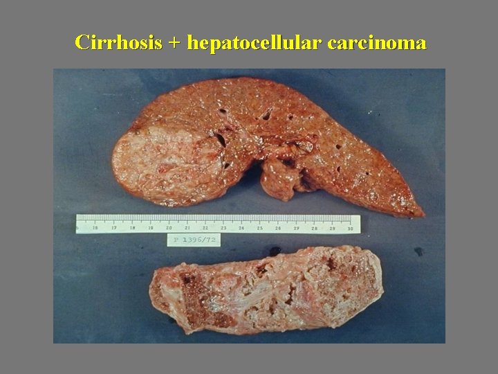 Cirrhosis + hepatocellular carcinoma 