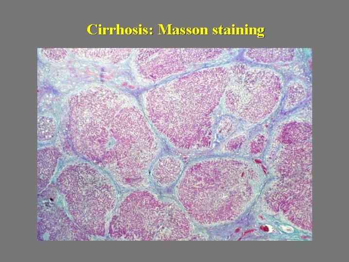 Cirrhosis: Masson staining 