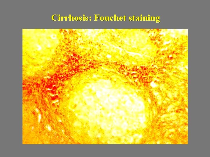 Cirrhosis: Fouchet staining 