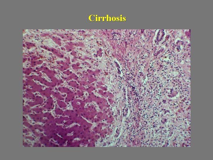 Cirrhosis 