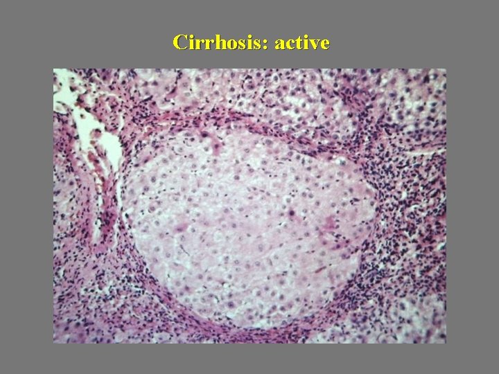 Cirrhosis: active 